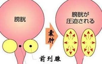 前列腺囊肿有哪些外在表现呢